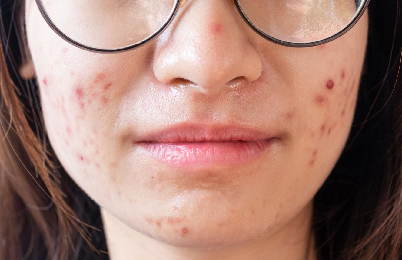 best facewash with salicylic acid for acne prone oily skin